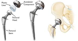 hip replacement