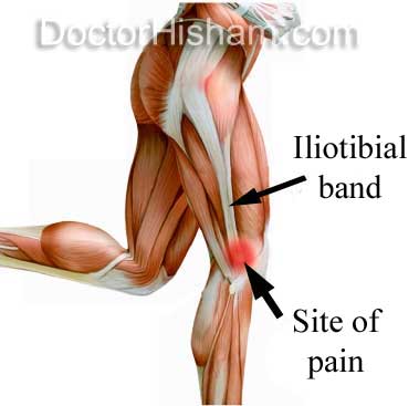 iliotibial tract (IT)
