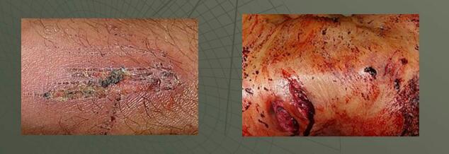 CONTUSIONES PROFUNDAS