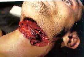 LESIONES POR INSTRUMENTOS CORTANTES