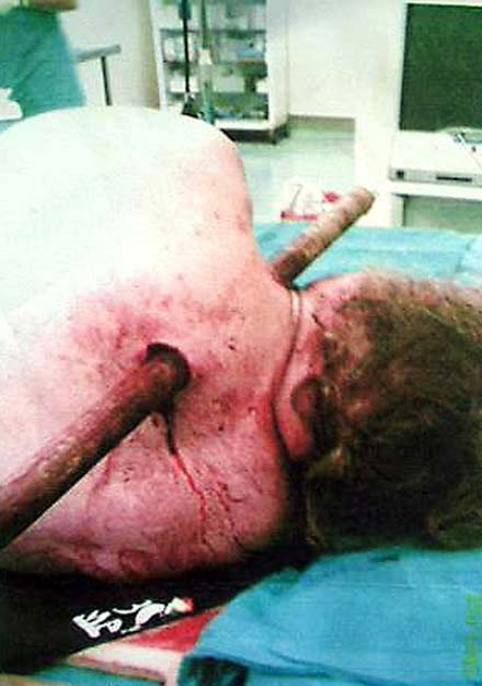 LESIONES POR INSTRUMENTOS PUNZANTES