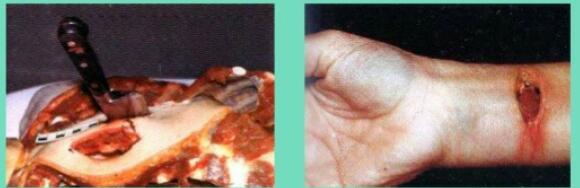 LESIONES POR INSTRUMENTOS PUNZOCORTANTES