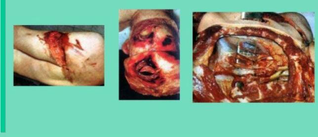 LESIONES POR INSTRUMENTOS CORTOCUNDENTES