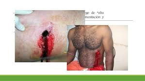 LESIONES POR PROYECTIL DE ARMA Y FUEGO