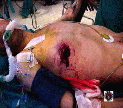 LESIONES POR ARMA BLANCA