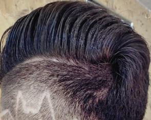 WAX oder Fadentechnik