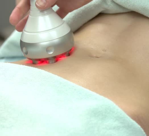 Body Contouring Radio Frequency