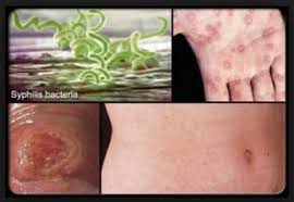 ramuan obat tradisional sipilis pada pria paling ampuh