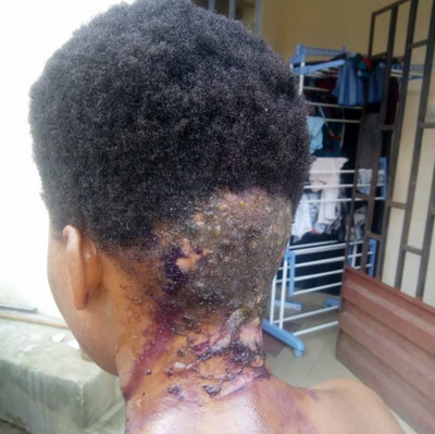 Landlady allegedly scalds tenant because of 370 Naira "NEPA" bill