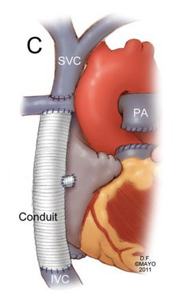 Dérivation cavo-pulmonaire totale