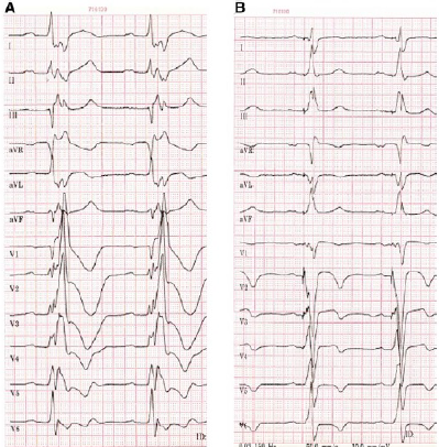 Arrhythmias in tetralogy of Fallot - Nicolas Combes