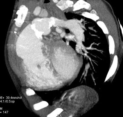 Pulmonary valve replacement : When is it indicated ? - Sébastien Hascoet