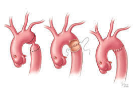 Repair of neonatal coarctation - Régis Gaudin