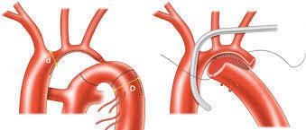 Coarctation and ventricular septal defec-Surgical strategies - Régis Gaudin