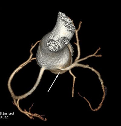 The problem of postoperative evaluation of coronary arteries after the ASO for TGA. Damien Bonnet, M3C Necker