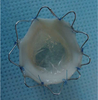 How to replace pulmonary valve percutaneously ? - Sophie Malekzadeh-Milani