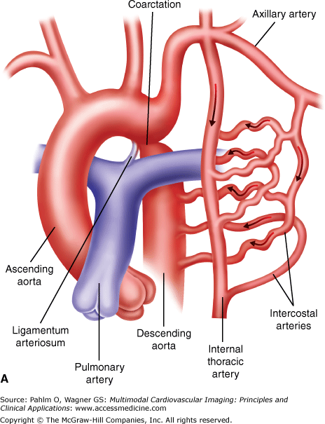 Interventional procedures in coarctations