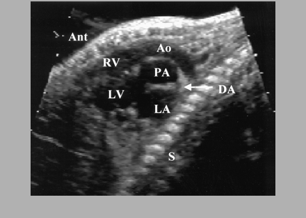 How to diagnose foetal transposition of the great arteries? Bertrand Stos, M3C-Necker