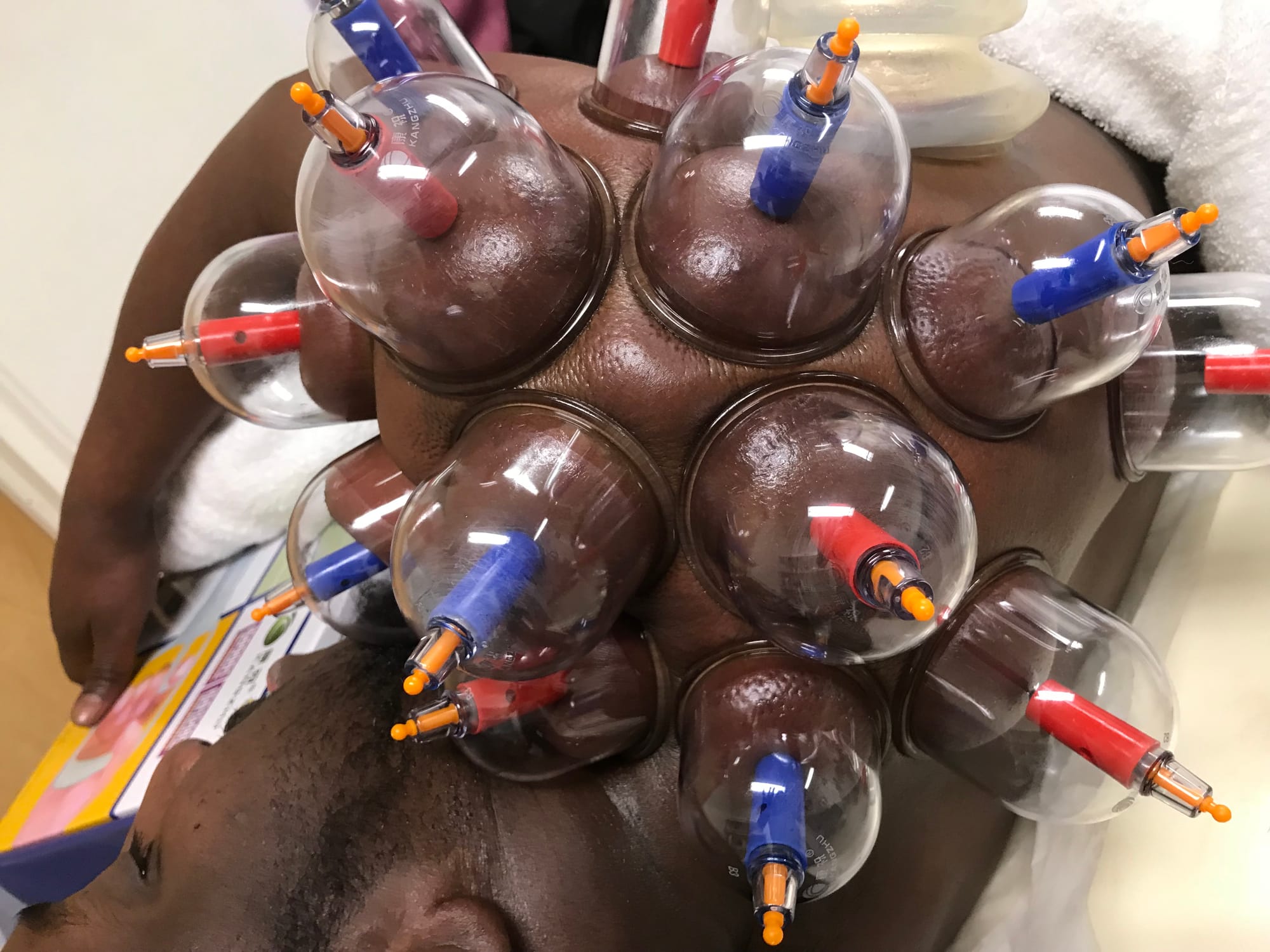 WHAT SHOULD I DO BEFORE HIJAMA (WET CUPPING)