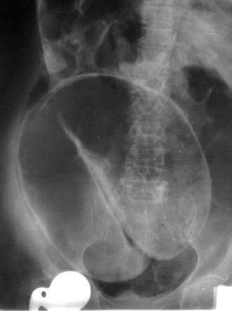 Sigmoid volvulus