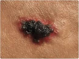 Skin cancers