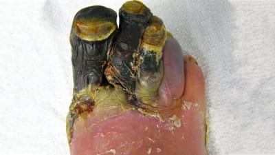 Chronic limb ischaemia