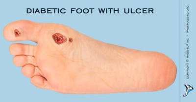 Diabetic foot History