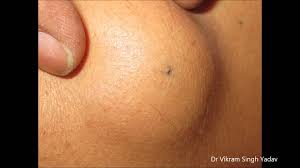 Examination of Sabaceous cyst