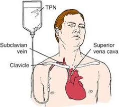 Total Parenteral Neutrition