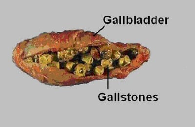 History of gall bladder diseases