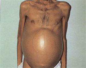 portal hypertension History