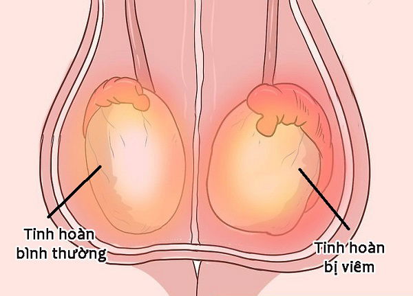 Bác sĩ cho lời khuyên về cách điều trị khi bị viêm tinh hoàn
