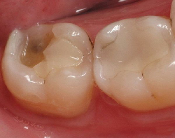 Trẻ bị vỡ răng mối nguy hại thường bị bỏ qua