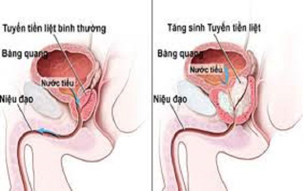 Điều trị viêm niệu đạo bao lâu thì khỏi dứt điểm?