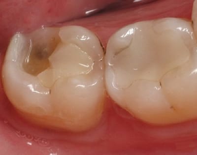 Trẻ bị vỡ răng mối nguy hại thường bị bỏ qua