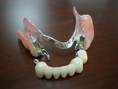 Các bước trong quy trình trồng răng giả như thế nào