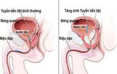 Điều trị viêm niệu đạo bao lâu thì khỏi dứt điểm?