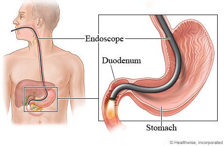 Gastroscopy