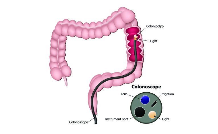 Colonoscopy