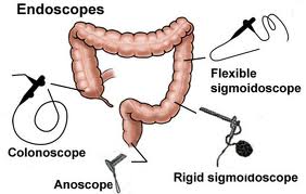 Flexible sigmoidoscopy