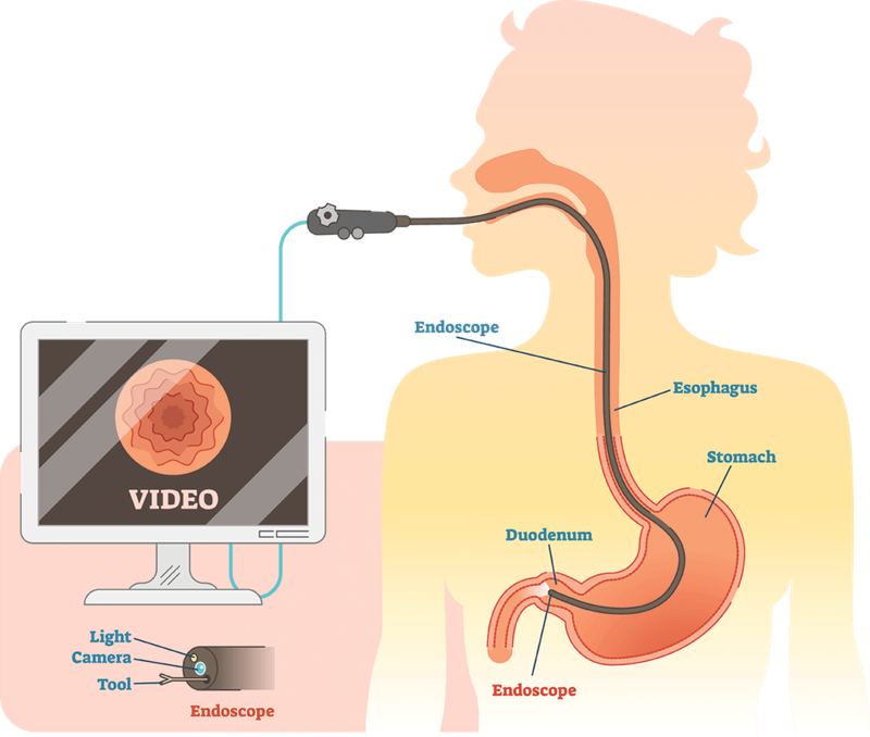 Endoscopic ultrasound (EUS)