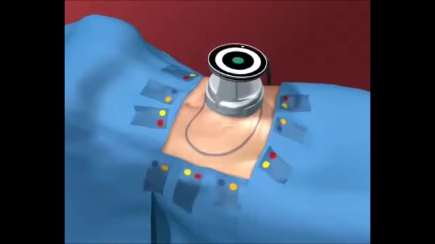 Ultrasonic Cavitation the Science