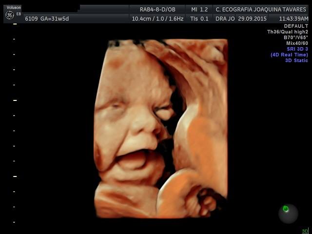 Ecografia Obstetricia Tridimensional - 3D/4D