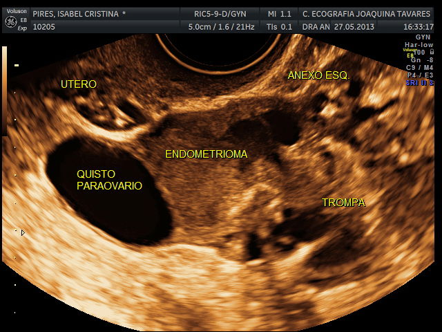 Ecografia Ginecológica com Sonda Vaginal