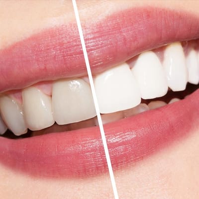 Lo sbiancamento dei denti nello studio odontoiatrico