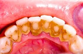 Pulizia dei denti