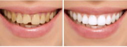 Smile Makeover image