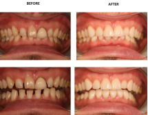 Smile Makeover image