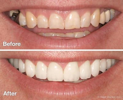 Smile Makeover image