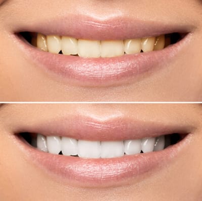 Teeth Whitening image